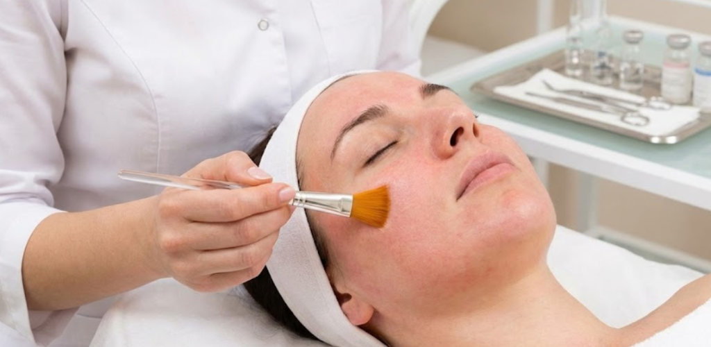 chemical peel ..